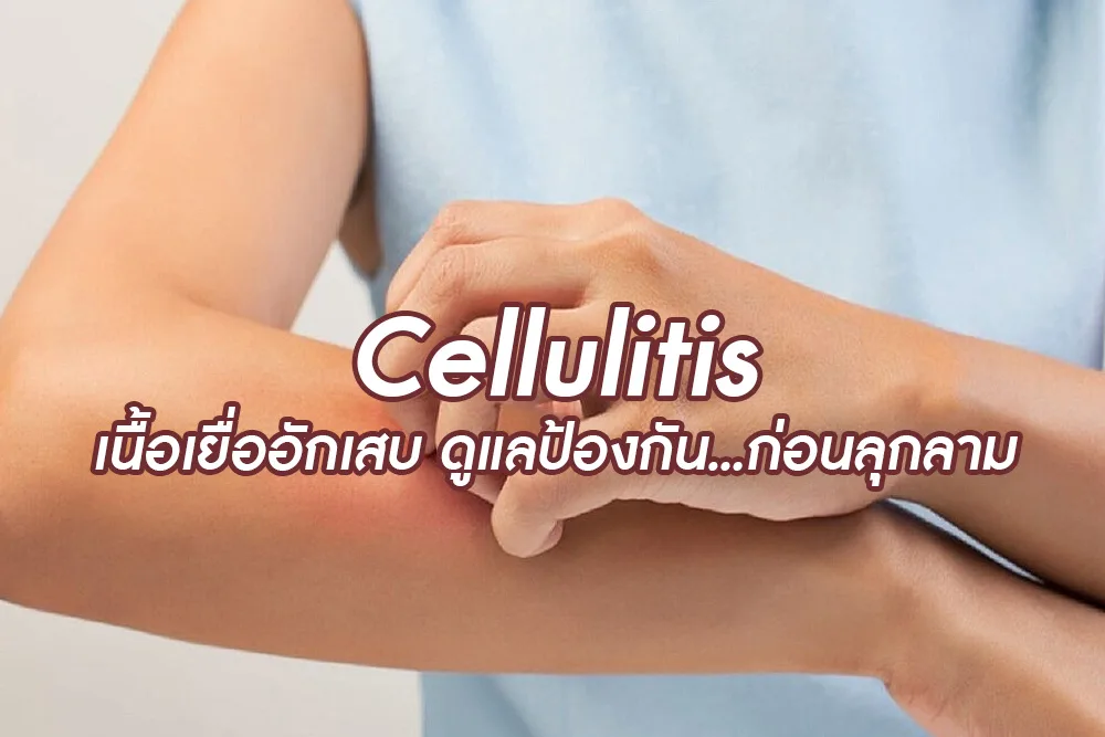 Cellulitis เนื้อเยื่ออักเสบ ดูแลป้องกัน ก่อนลุกลาม